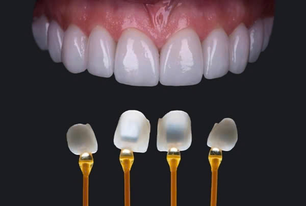 Bảo Hành Răng Sứ Nha Khoa